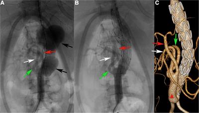 Hybrid surgery management challenges of a Behcet's disease patient with recurrence of aortic aneurysms: a case report